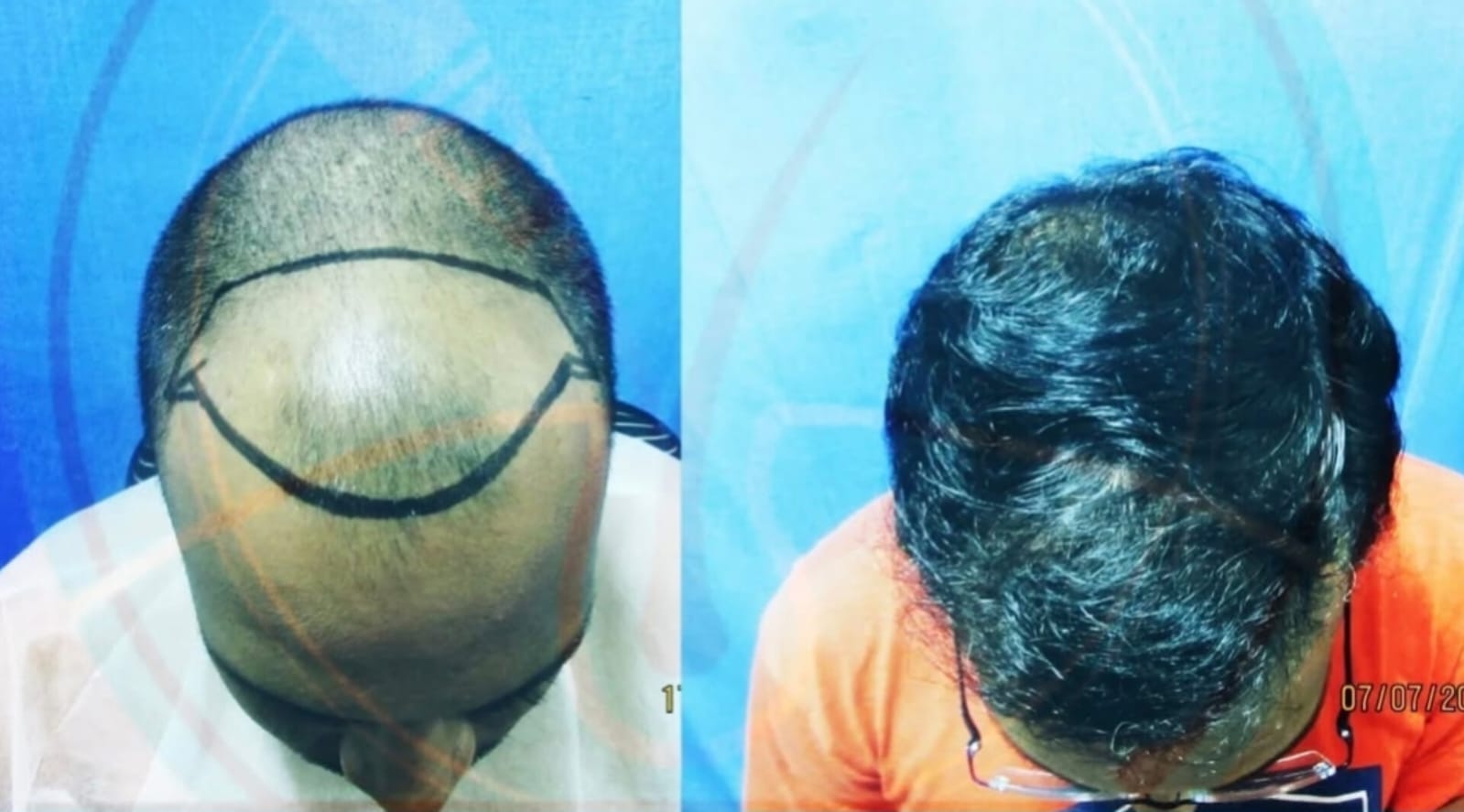 Before After